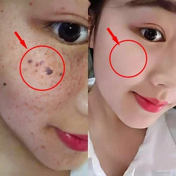 Rose Æterisk Olie Nærende Hud Fjernelse Af Modermærke Fregner Facial Lysere Kridtning Olie Face Serum